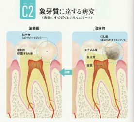 むし歯の予防と治療