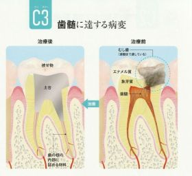 むし歯の予防と治療