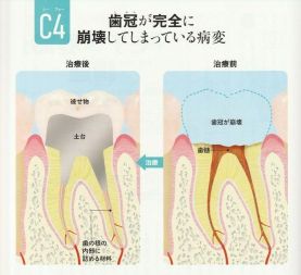 むし歯の予防と治療