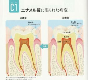 むし歯の予防と治療