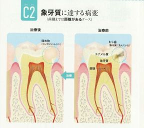 むし歯の予防と治療